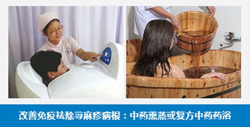 荨麻疹较好的治疗方法