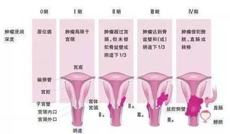 姐妹们,宫颈癌疫苗要不要打